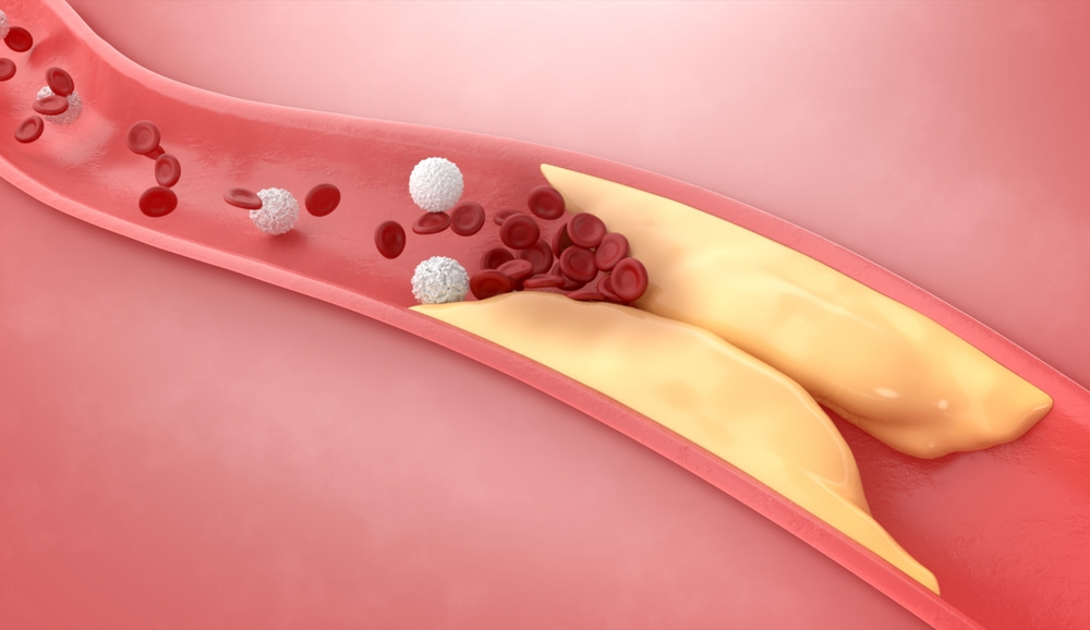 Imagem ilustrativa de artérias e veias espessadas, renderização 3D.